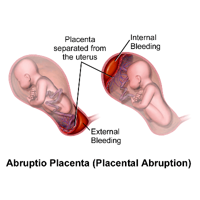 Pregnancy Associated with APH and PPH